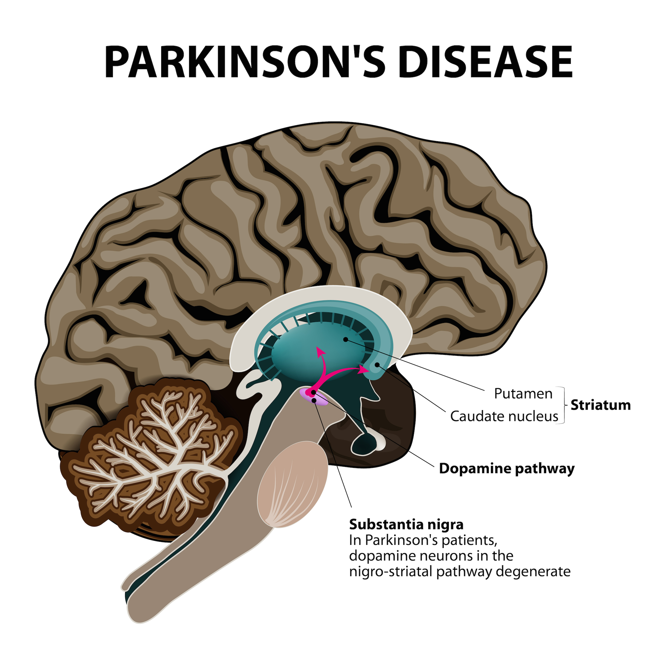 Parkinson's image resized.jpg